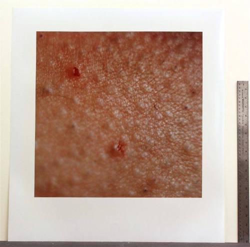 Fissure